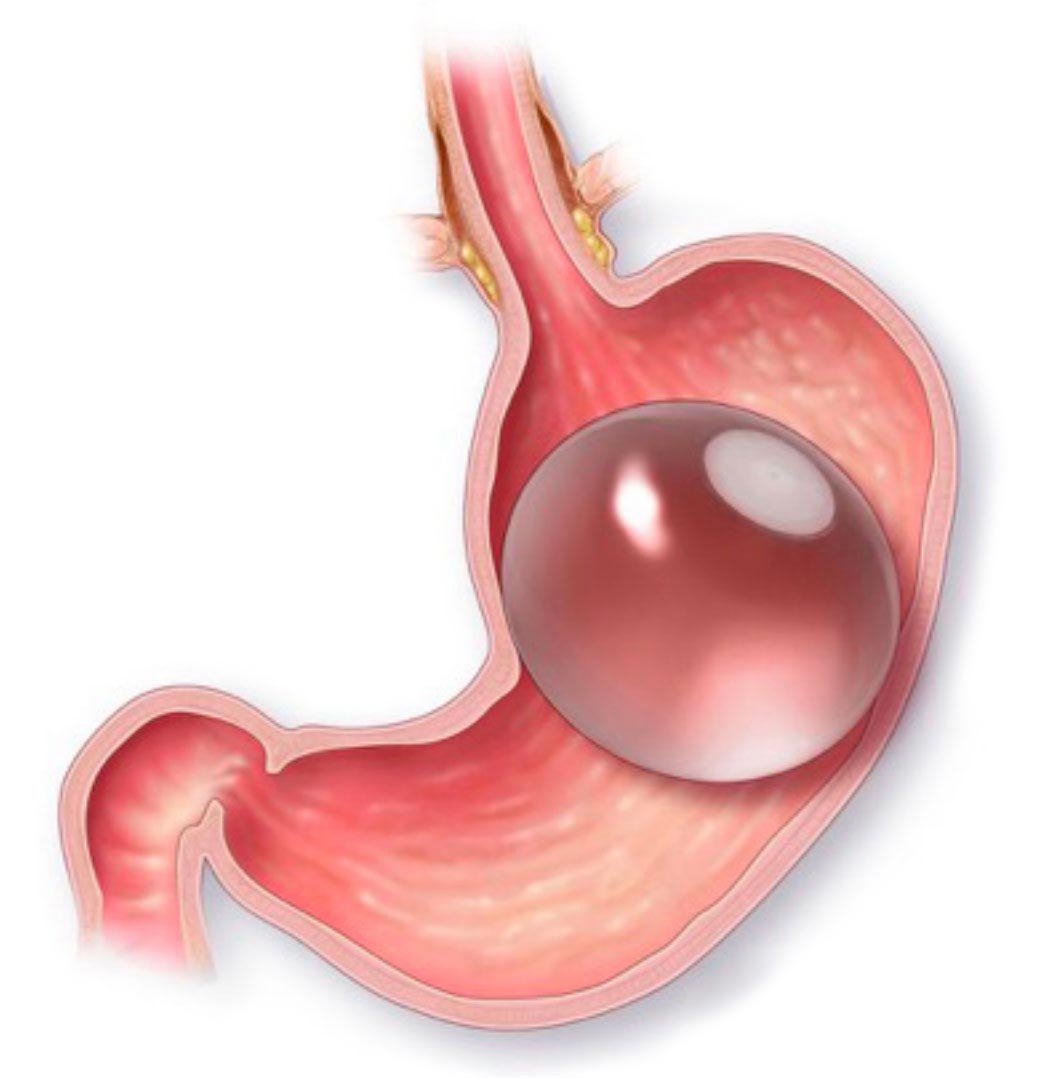 Gastric Balloon New Jersey