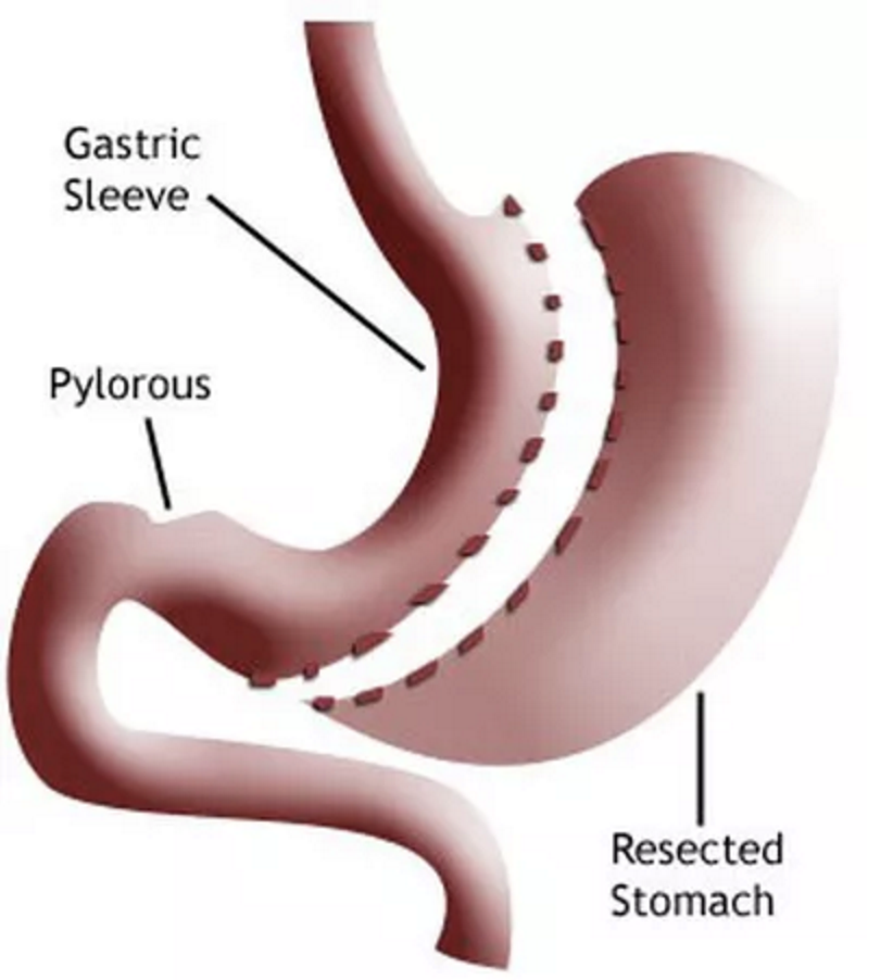 Gastric Sleeve New Jersey