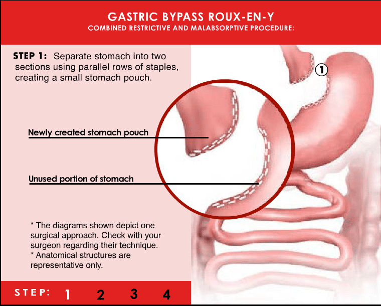 Gastric Bypass NJ
